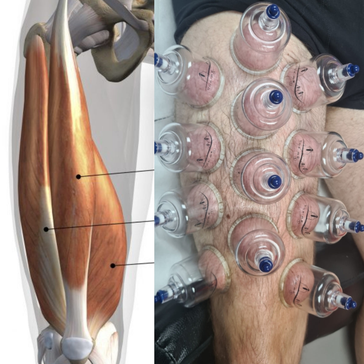 Malette XXL de 30 ventouses de cupping